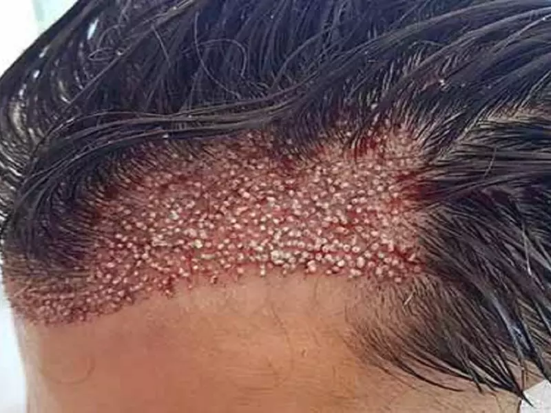 کلینیک زیبایی دکتر درنا تبریزی کاشت مو در شیراز عفیف آباد