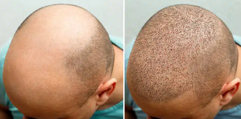 کلینیک درنا تبریزی خدمات کاشت مو در شیراز عفیف آباد