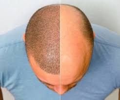 درنا تبریزی متخصص کاشت مو در شیراز قصر دشت