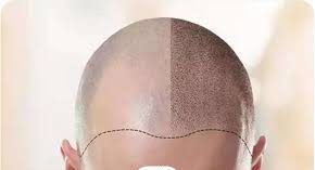 درنا تبریزی متخصص کاشت مو در شیراز قصر دشت